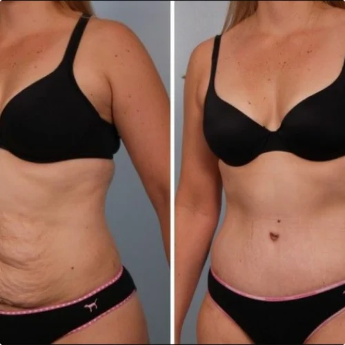 slimtime before after 1