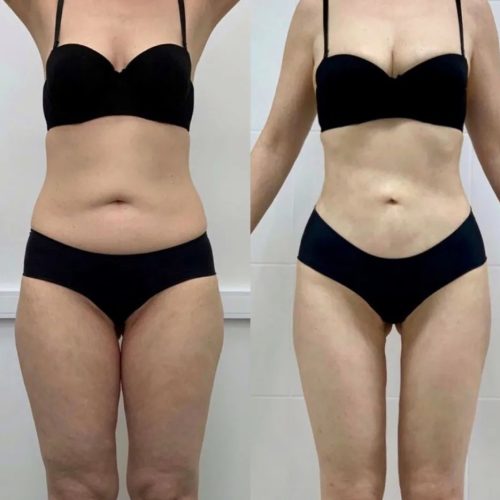 slimtime before after 2