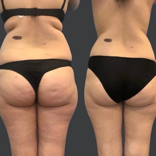 slimtime before after 4