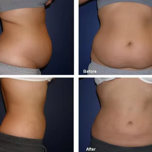 slimtime-before-after 6
