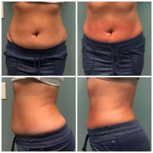slimtime-before-after 7