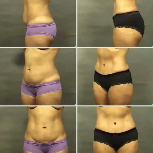 slimtime before after 9